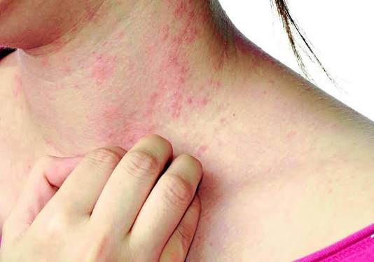 Darmparasiten Symptome: Anzeichen erkennen, Ursachen verstehen und richtig handeln
