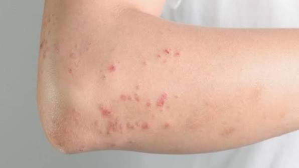 Darmparasiten Symptome: Anzeichen erkennen, Ursachen verstehen und richtig handeln