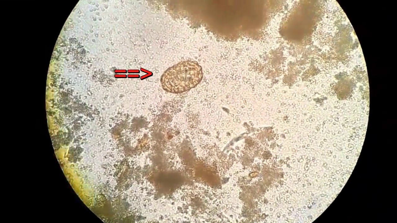 Parasiten im Stuhl: Ursachen, Symptome, Diagnose und Behandlung